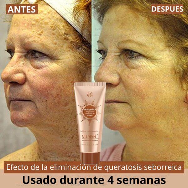Clarevié™ - Mascarilla facial iluminadora y eliminadora de manchas